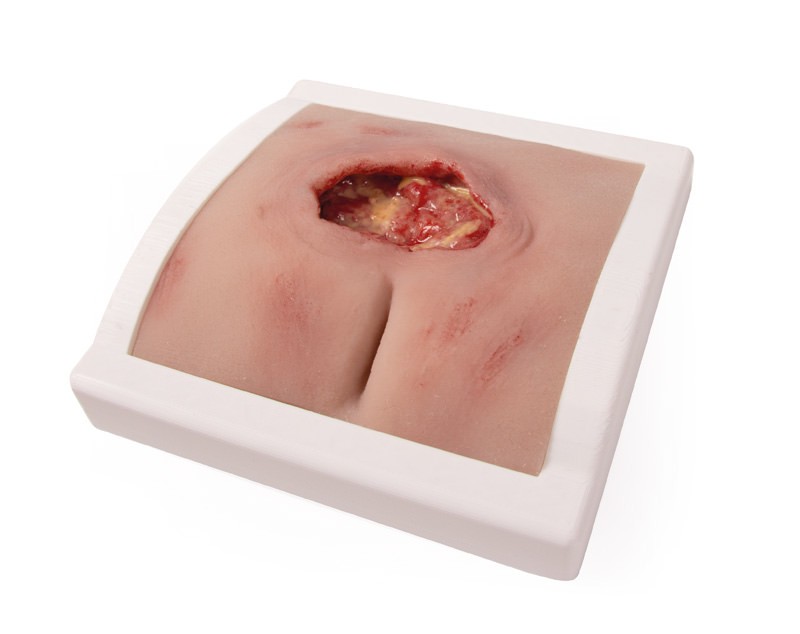 Wundmoulage sakraler Dekubitus