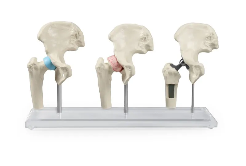 Hüft-Implantat-Modell
